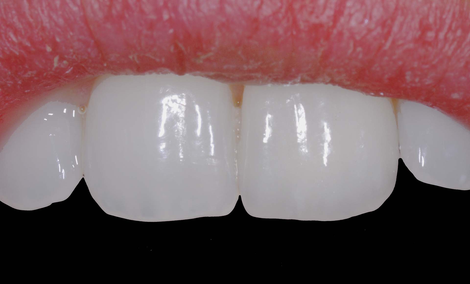Veneer 21